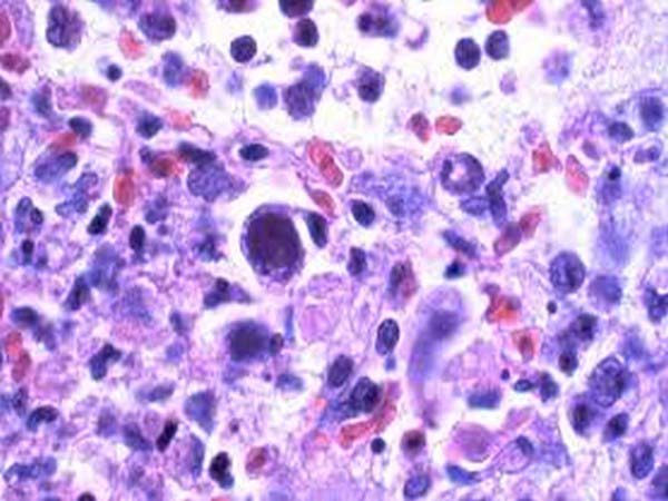 A cytomegalovirus infection