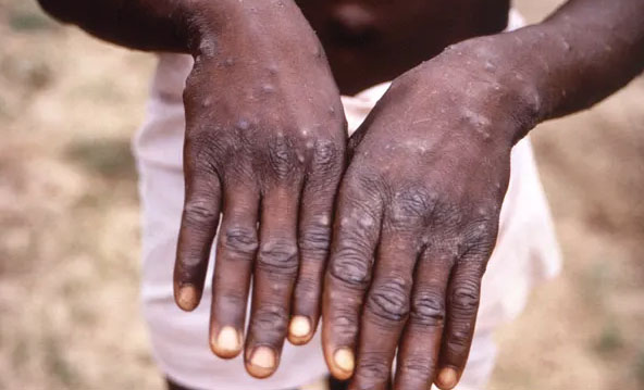 UAE becomes first Gulf country to report monkeypox case (File Photo)