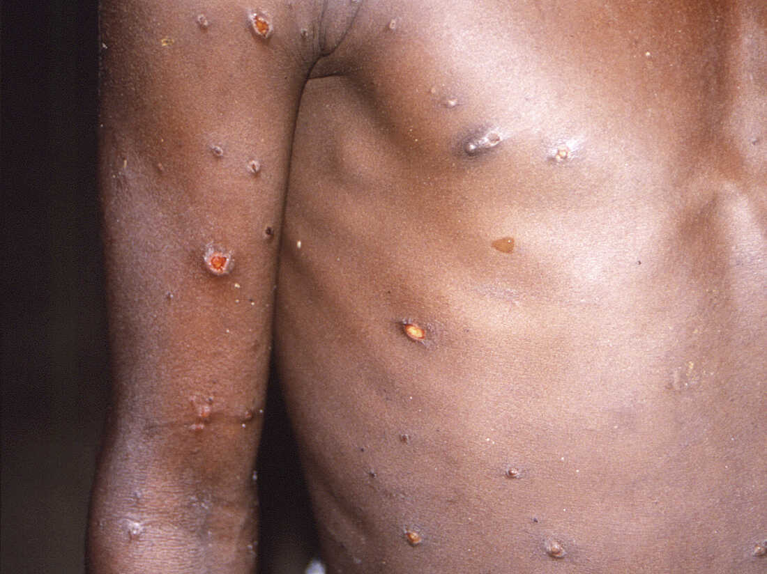 Monkeypox is a viral zoonosis (File Photo)