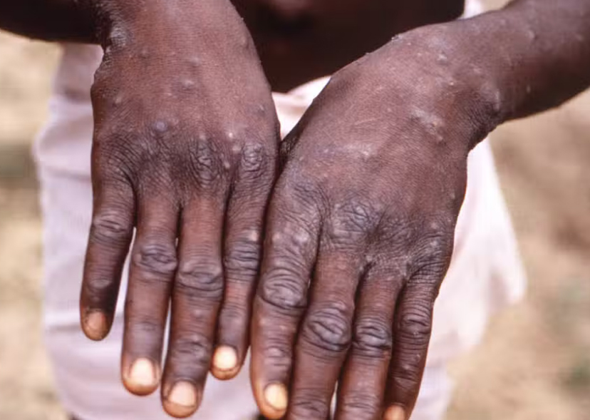 Monkeypox caused no deaths in Europe (File Photo)