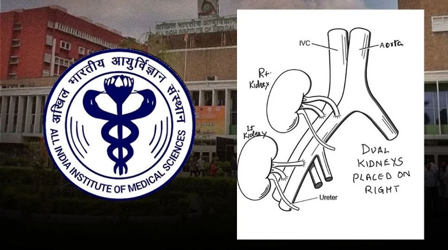 AIIMS Delhi performs first dual kidney transplant